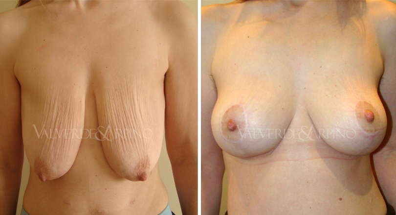 Breast elevation without prosthesis