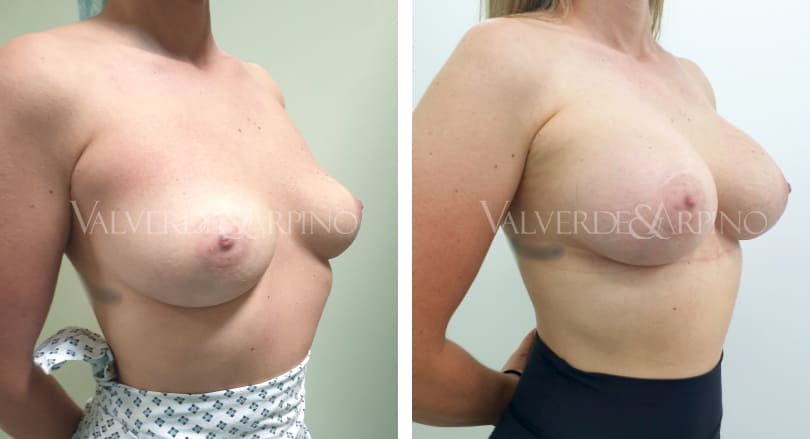 Cirugía mamaria deportista