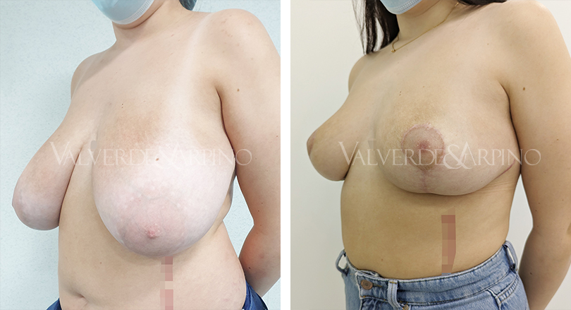 Hipertrofia mamaria virginal