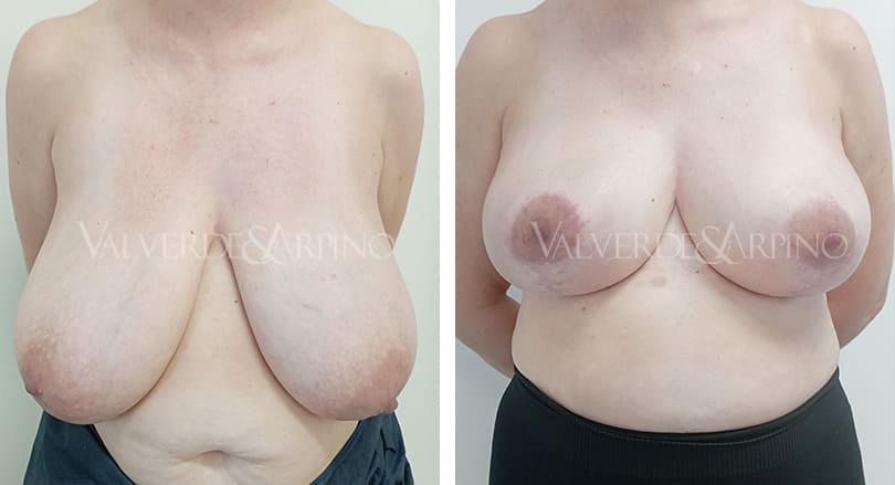 Elevación mamaria sin implantes