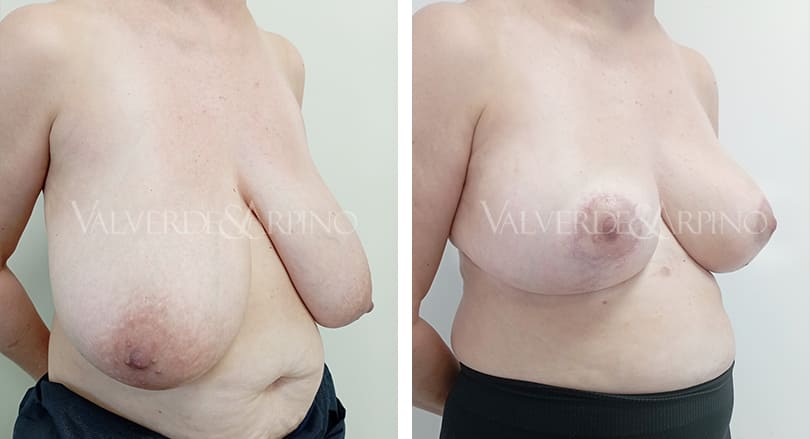 Elevación mamaria sin implantes