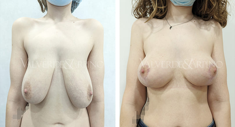 Reconstrucción mamaria sin implantes