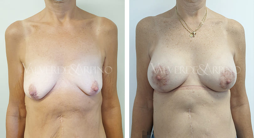 Elevación mamaria con implantes