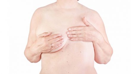 Breast reconstruction