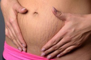 Mini-abdominoplastia: la alternativa a la Abdominoplastia