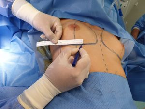 VA - pasos aumento mamario 1 medir