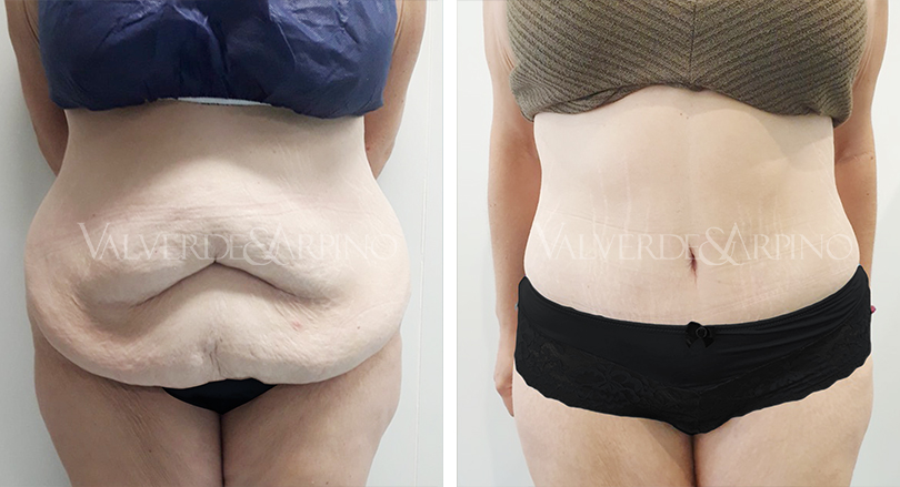 Abdominoplastia
