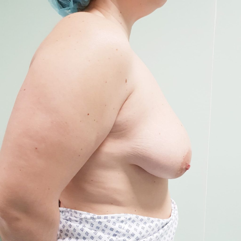 Elevación con implantes