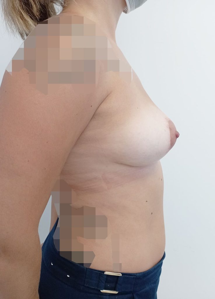 Cirugía mamaria secundaria