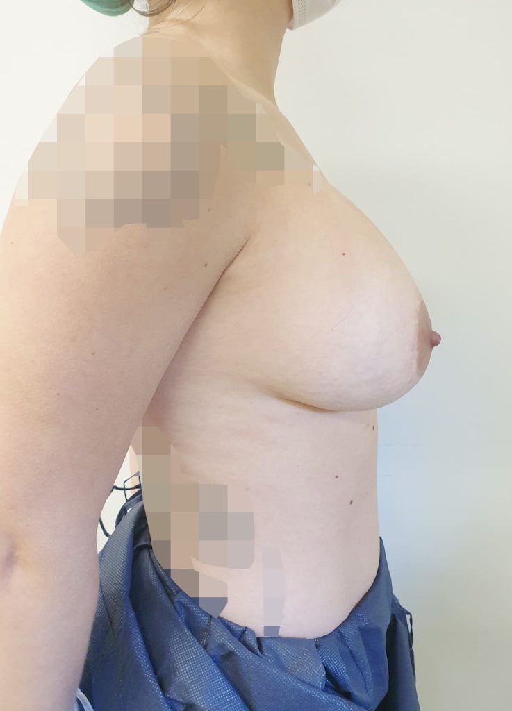 Cirugía mamaria secundaria