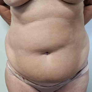 Abdominoplastia