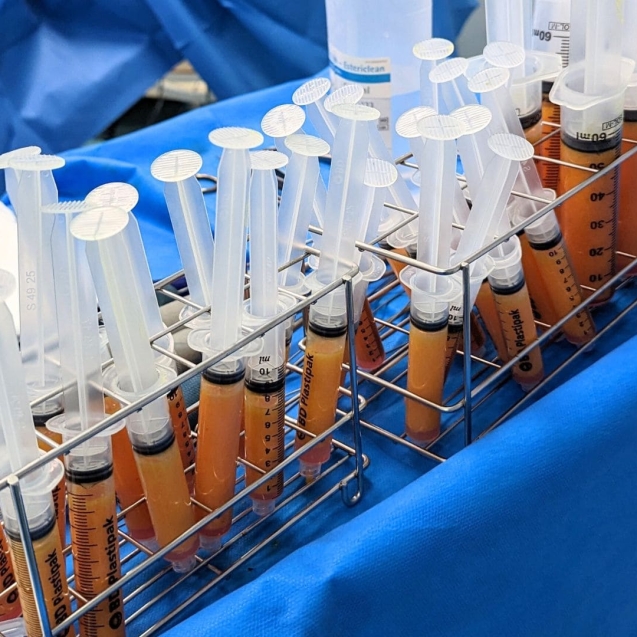 Liposucción y aumento de pecho con grasa