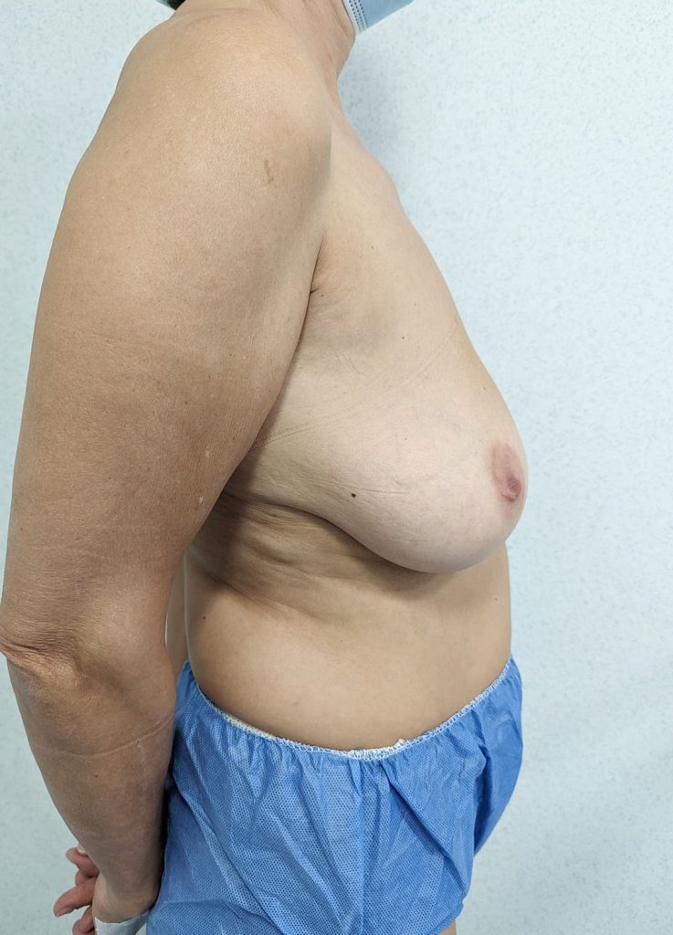 Elevación mamaria