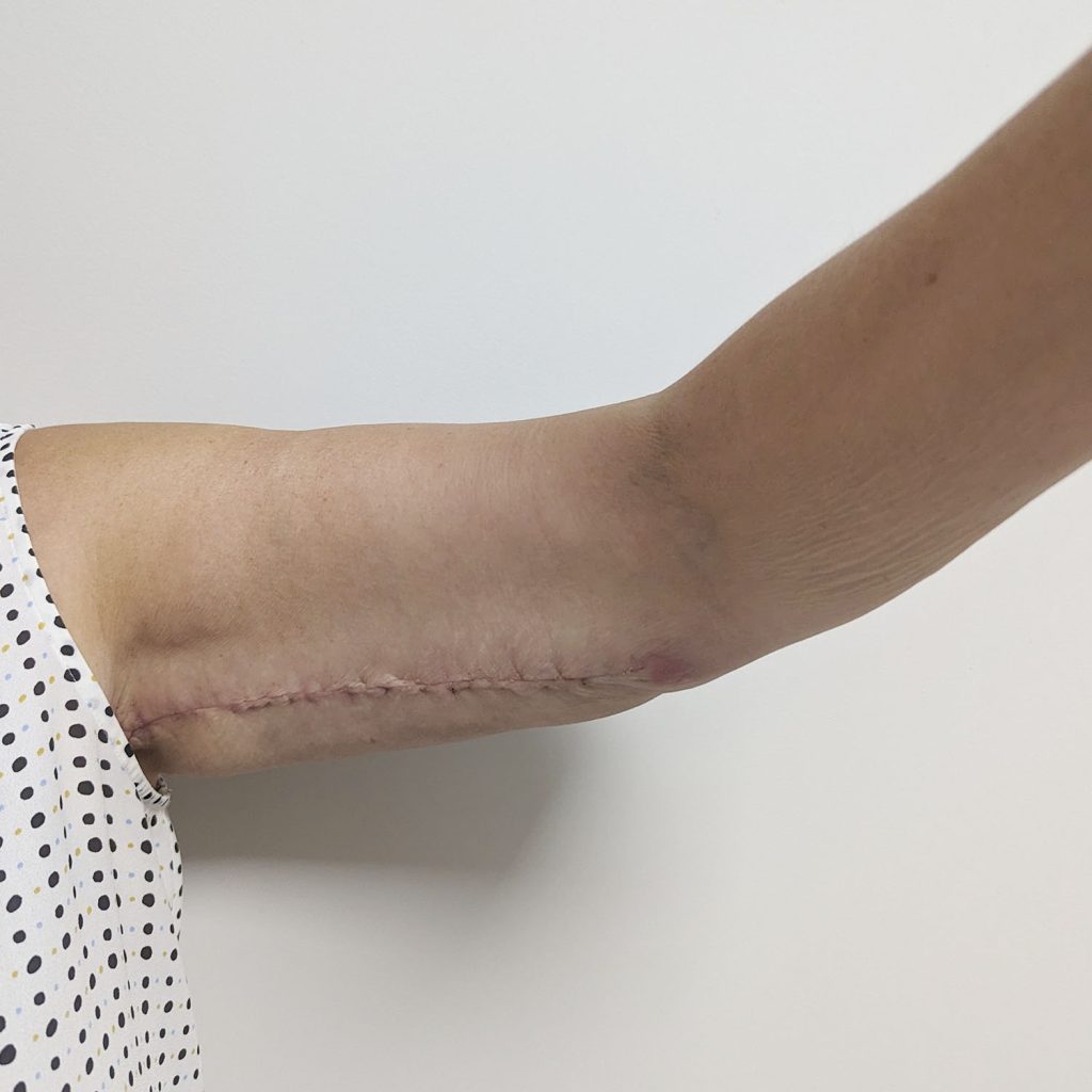 Descolgamiento de la piel del brazo