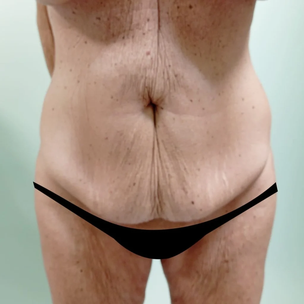 Cirugía de abdomen