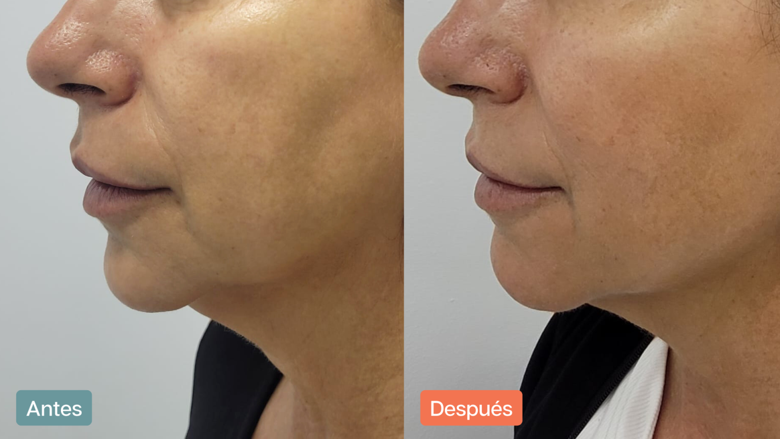 eliminar la papada en Alicante