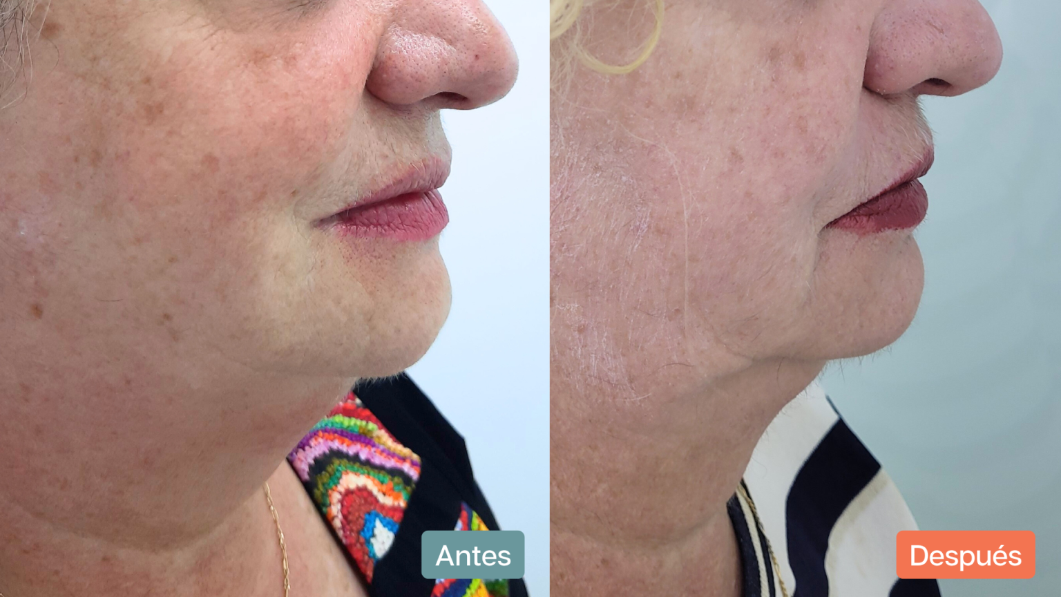 eliminar papada en alicante con coolsculpting