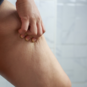 lifting de muslos antes y después