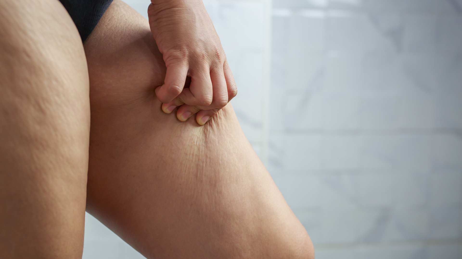 lifting de muslos antes y después