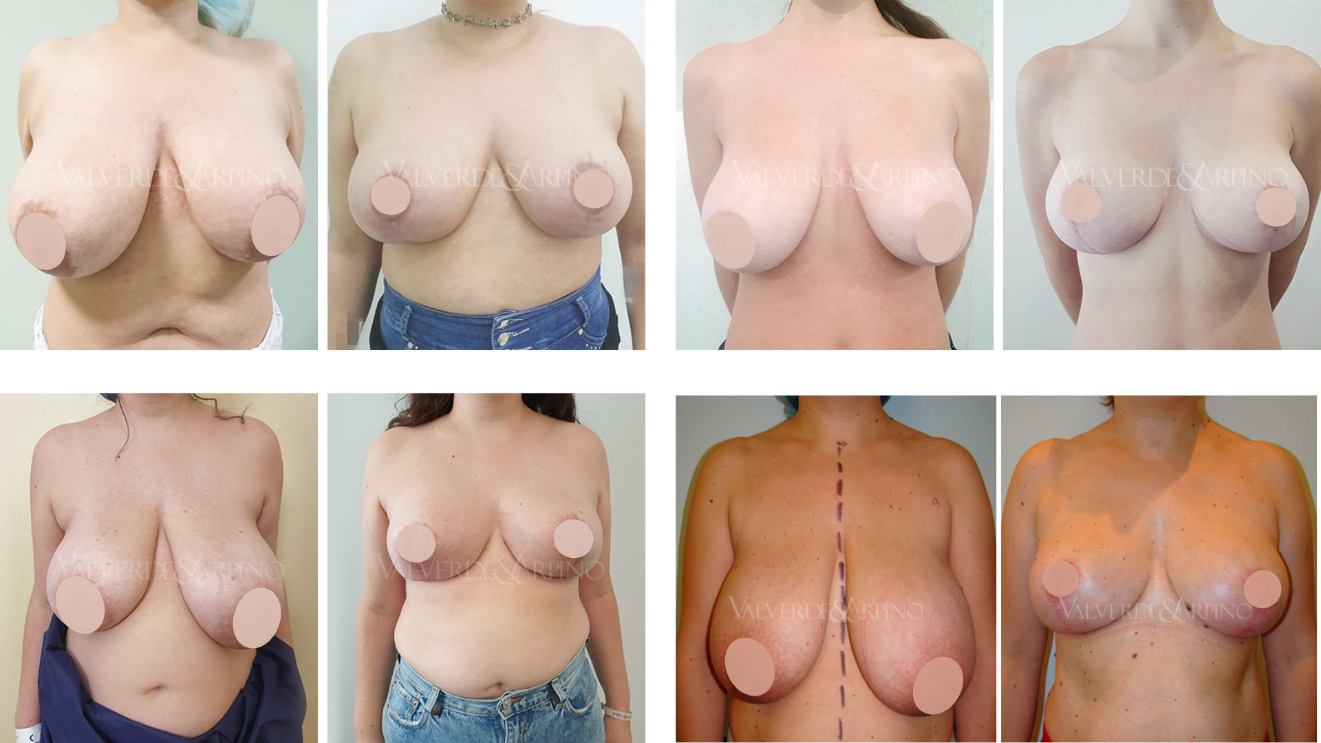 reducción de pecho en Alicante