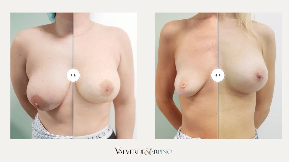 Solución a pecho caído en Alicante