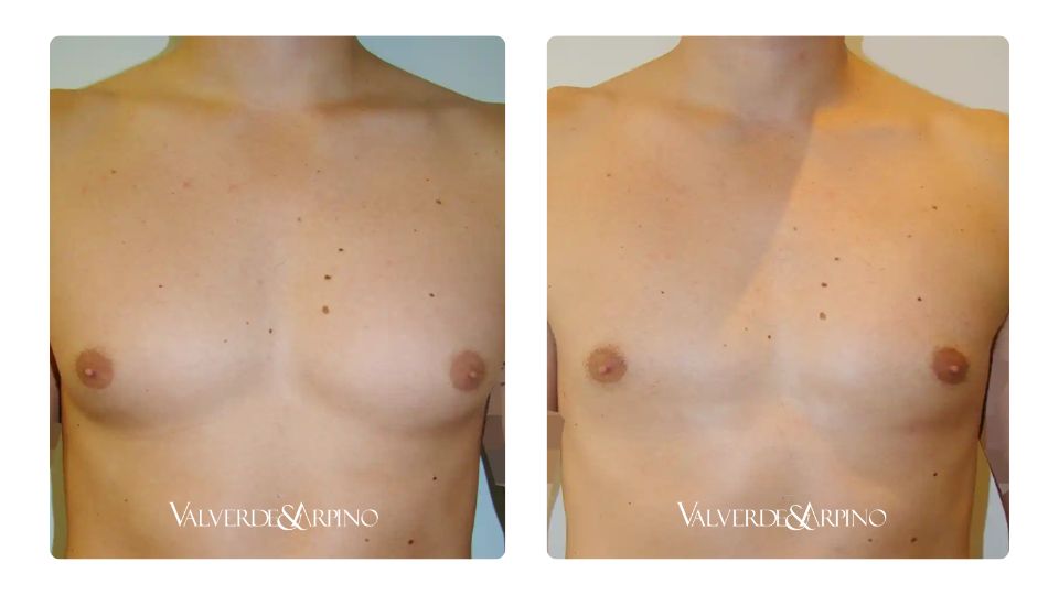 Tratamiento ginecomastia en hombres en Alicante - antes y después